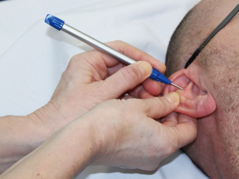 Patient får øreakupunktur