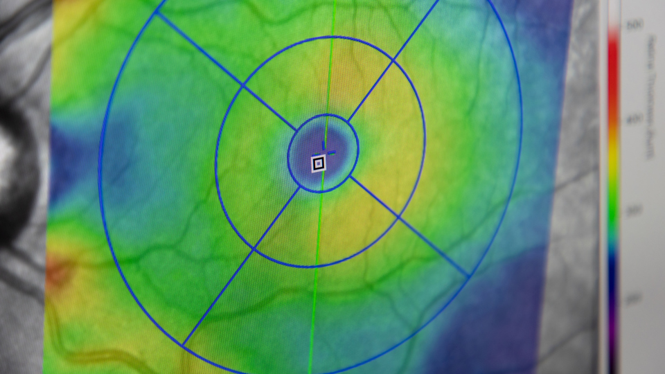 Scanningsbilledet viser tykkelsen af det nervelag, der er i øjet.