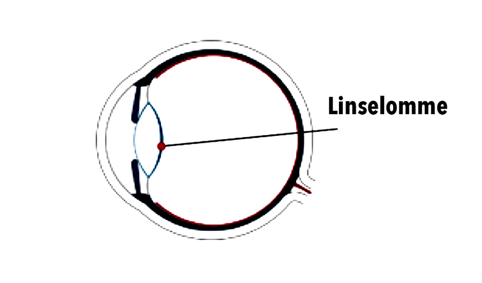 Tegning af øjet set fra siden. Linselommen er illustreret i den forreste del.
