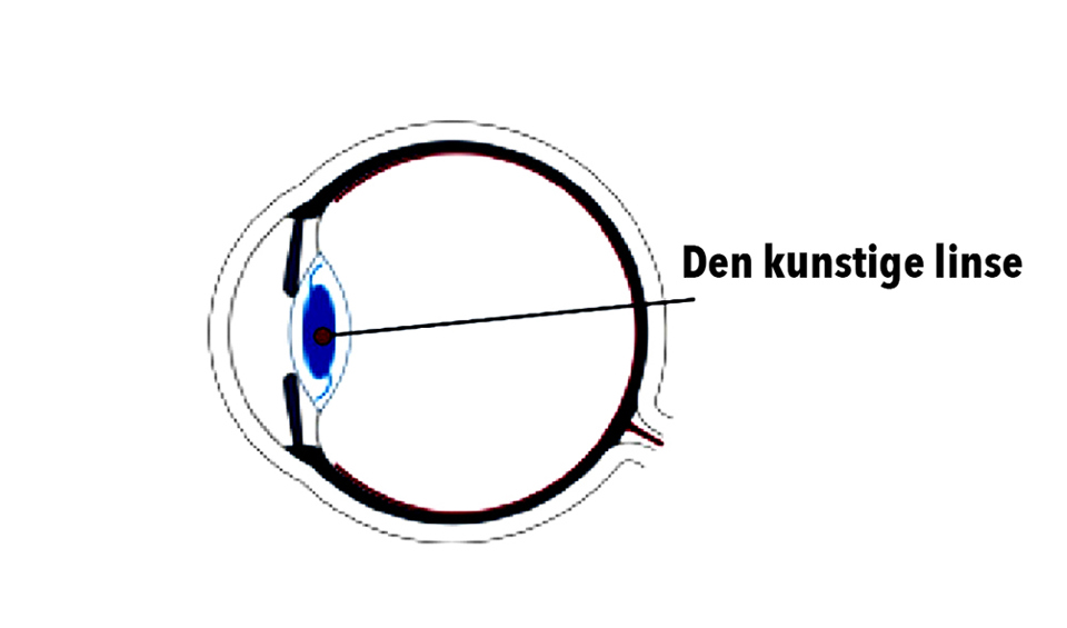 Tegning af øjet set fra siden, hvor den nye linse er placeret i linselommen.